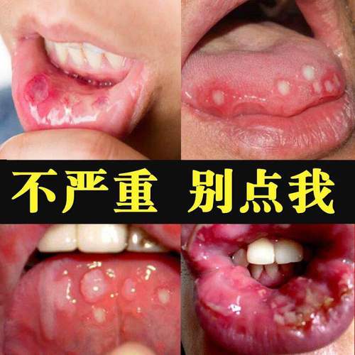 名称:复发性口腔溃疡益康口腔散剂 1盒品牌:美度(meidu)加入购物车本